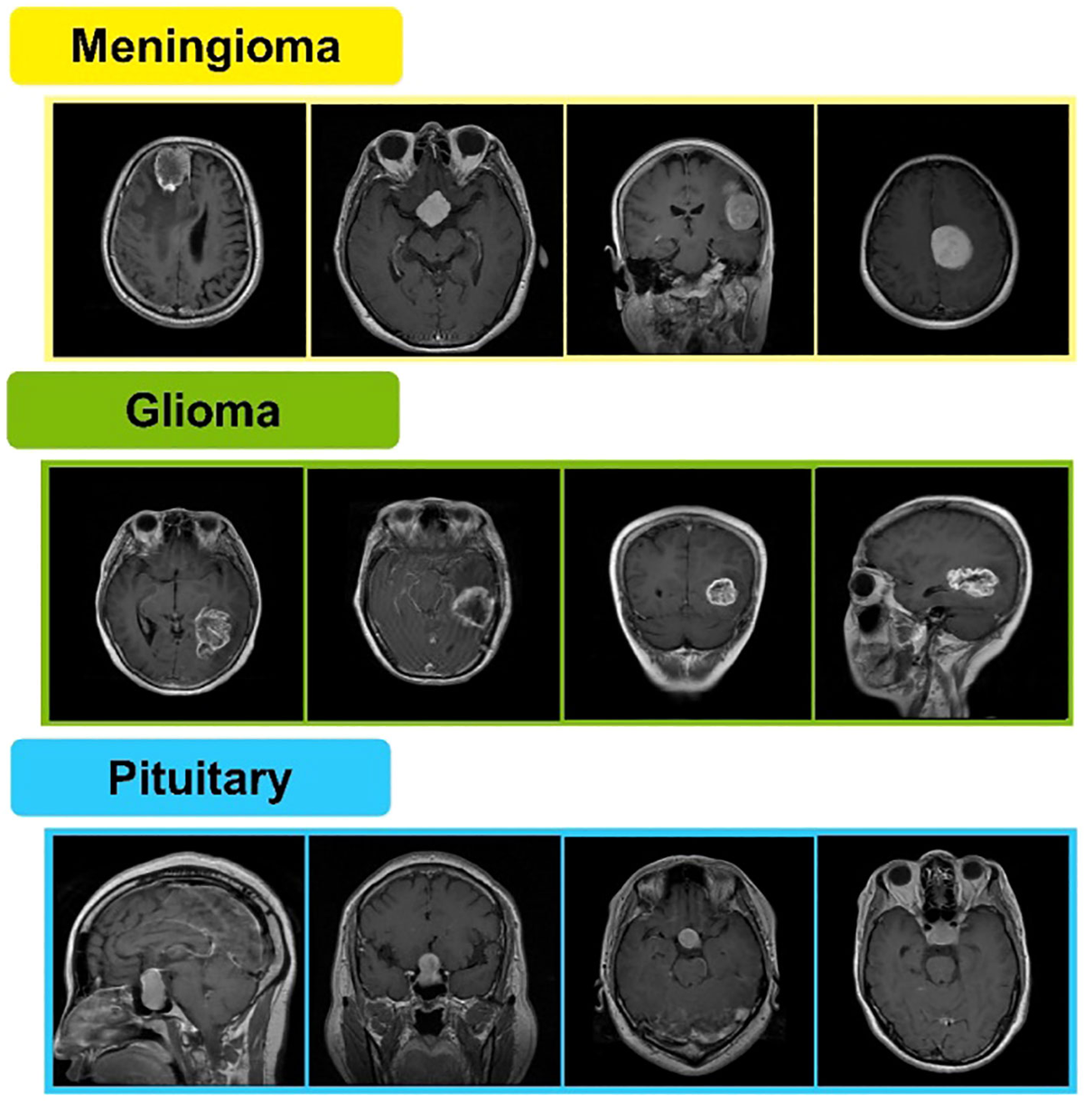 deep learning tumor